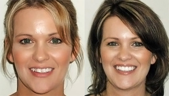 Invisalign Before and After Stories With Our Patients - Gorman